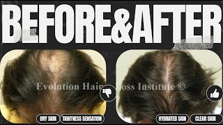 Bring back your hair in 30 days  How to treat hair fall  Scientific method  100  working [upl. by Nirtiak198]