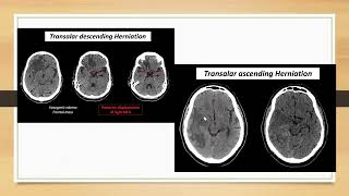 Brain herniation [upl. by Marou]