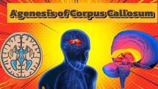 Agenesis of Corpus Callosum Brain Disorder 🧠 🧠🧠🧠🧠 [upl. by Demaggio812]