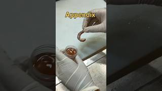 Appendicitis specimen [upl. by Rimaa459]