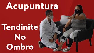 Acupuntura para Tendinite no Ombro [upl. by Trinity]