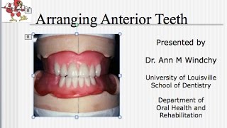 Video 17  C D Arrangement of the Anterior Teeth  Lecture [upl. by Isaiah7]