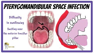 PTERYGOMANDIBULAR SPACE INFECTION  Boundaries clinical features management [upl. by Batish]