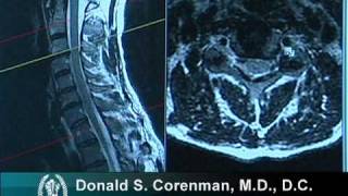 How to Read a MRI of Cervical Nerve Compression  Neck Pain  Colorado Spine Surgeon [upl. by Towland]