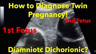 Twin Pregnancy  Diamniotic Dichorionic how to diagnose  easy steps [upl. by Sadowski157]