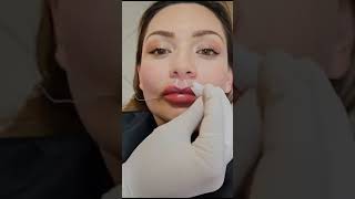 👄 Estos labios que  viral dentista dentalcare odontologia [upl. by Jordanna]