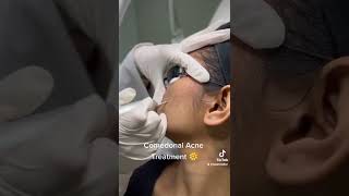 Comedonal Acne Treatment by CO2 laser [upl. by Mireille]