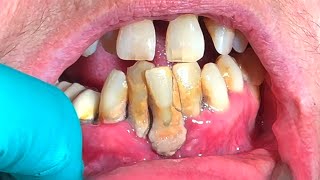 10 Years of Dental Neglect amp Bone Loss What Can Be Done [upl. by Chiles]