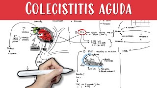 COLECISTITIS AGUDA colecistitis colelitiasis coledocolitiasis colico biliar murphy [upl. by Niemad957]