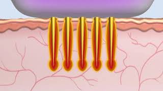 The Secret MicroNeedle Fractional RF  How it works by Dr V  V Boutique Aesthetics [upl. by Ennovaj]