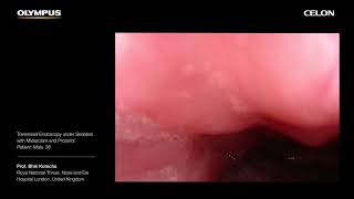 Drug Induced Sleep Endoscopy with CELON  Prof Bhik Kotecha  Part 3 [upl. by Ailegave]