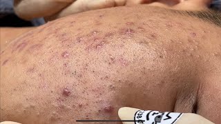 Blackheads amp Pimples Pore Removal New 2024  Acne Treatment With Bo Nguyễn Spa [upl. by Alahcim]