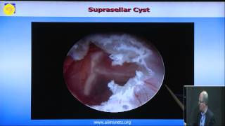 ETV and endoscopic intraventricular cyst management [upl. by Wooster]