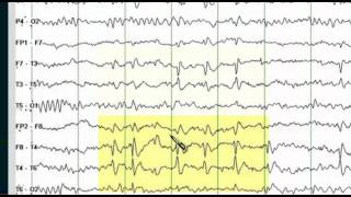 Focal EEG Abnormalities 1 [upl. by Lynnett]