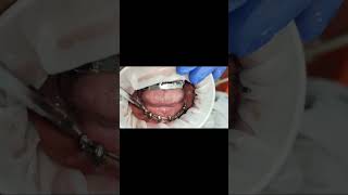 Regular single piece implants Vs multiunit single piece implantshealingamptapping test post 6 months [upl. by Andrew]