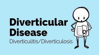 Diverticular Disease  Diverticulitis  Gastrointestinal Society [upl. by Gurevich]