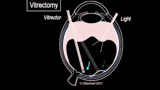 Vitreous 3 Vitrectomy Surgery [upl. by Stauder32]