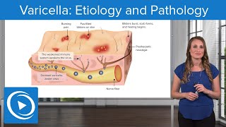 Varicella Etiology and Pathology – Pediatric Nursing  Lecturio Nursing [upl. by Llerrit250]