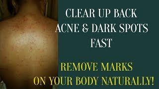 How To Clear Back Acne and Remove Marks Brown or Dark Spots On Your Body Easy Natural Oil Mix [upl. by Setarcos]