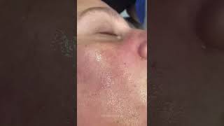 Clogged Pores amp how we unclog them  Dr Medispa [upl. by Haon]