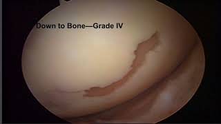 Knee Chondromalcia and Its Treatment [upl. by Adilen66]