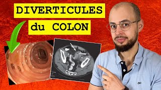 Diverticules du COLON  Les complications possibles [upl. by Okomom]