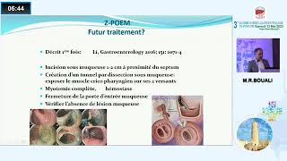 Traitement endoscopique du diverticule de Zenker Dr Riadh Bouali [upl. by Leahcimed]