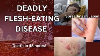 Deadly FleshEating Disease  STSS  News  What you need to know [upl. by Eiuol]