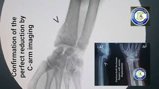 Communited fracture Lower end Radius  Wrist  forearm injuries  Closed reduction  Kwire  Adamya [upl. by Rondon200]