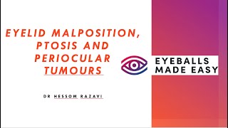 Eyelid malposition ptosis and periocular tumours [upl. by Hanzelin166]