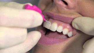 How to use an interdental brush  AJ Hedger [upl. by Nolubez]