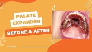 Palate Expander Installation Before and After [upl. by Yelime498]