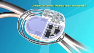 Medtronic Advisa™ DR MRI SureScan™ Pacemaker Video [upl. by Eirrac]