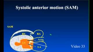 SAM  Systolic Anterior Motion in Feline Cardiomyopathy [upl. by Ludlow]