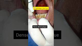 ازالة وتنظيف جير الاسنان ازالة بلاكوالاسنات والقلح dentist stitch اكسبلور stitchlover ترند [upl. by Arreis]