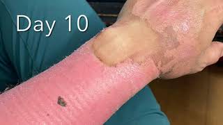 Healing Progress Of Second Degree Burns [upl. by Weksler53]