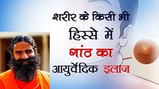 शरीर के किसी भी हिस्से में गांठ का आयुर्वेदिक इलाज  Swami Ramdev [upl. by Repsac]