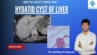 Hydatid Cyst of Liver  An important Question asked in FMGE 2024  Expected in NEET PG [upl. by Juni538]