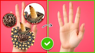 ASMR Remove Maggots amp Dog Ticks From Hand  Severely Injured Treatment Animation [upl. by Falzetta]