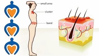 Shingles  The causes symptoms treatment and prevention [upl. by Aicatsue977]