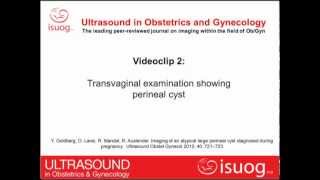 Imaging of an atypical large perineal cyst diagnosed during pregnancy [upl. by Madelena839]