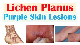 Lichen Planus “Purple Skin Lesions”  Causes Signs amp Symptoms Diagnosis Treatment [upl. by Roosevelt121]