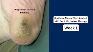 Plantar Wart treatment Before And After Images [upl. by Yeliah544]