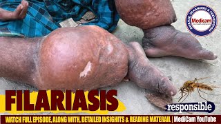 🦟Filariasis Lymphatic Filariasis Causes Symptoms and Treatment Options [upl. by Aidnyc321]