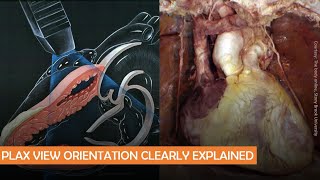 Parasternal long axis echocardiographic view anatomy POCUS pearls  Dr Koratala [upl. by Faso]