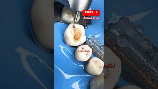 Dental Cavity preparation part 1 cavities vibe viral dentist smile teethshorts videoviral [upl. by Irpac]