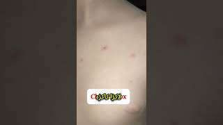 Chicken Pox Signs amp Symptoms  Lakra Kakra ki ilamat  Know the Risks amp Prevention [upl. by Rabma148]