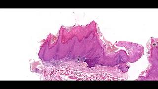 Hyperplasia and Hyperkeratosis [upl. by Adnirb]