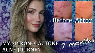 SPIRONOLACTONE FOR HORMONAL ACNE BEFORE  AFTER PICTURES MY EXPERIENCE AND WHY I STOPPED TAKING IT [upl. by Attenol324]