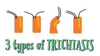 3 types of Trichiasis Distichiasis Entropion and Trichiasis EyeDocSkills [upl. by Ireva721]